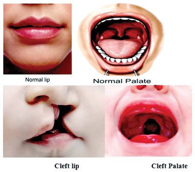 An Unanticipated Breastfeeding Journey Cleft Lip And Palate Sunday