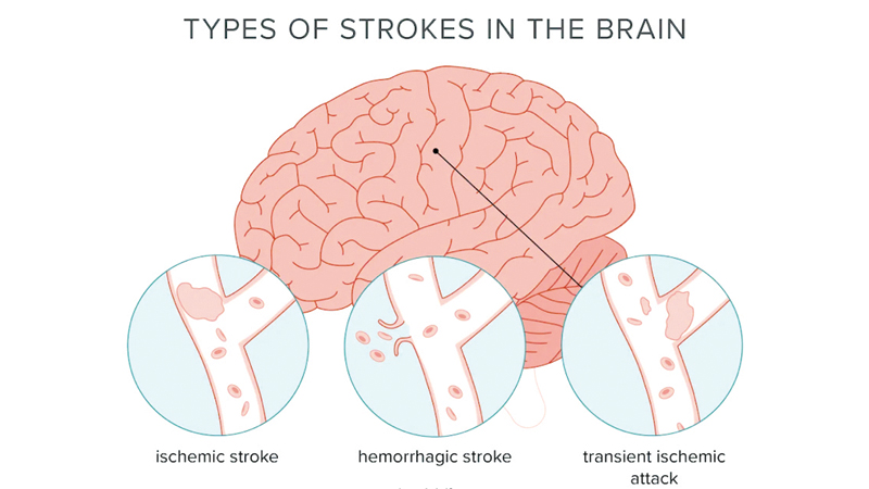 Prevent strokes with healthy lifestyles, nutritious diets and early ...